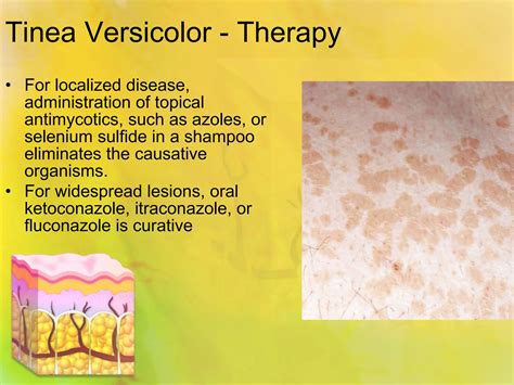 Spongiotic dermatitis tinea | PPT