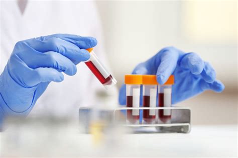 C Reactive Protein & hs-CRP Blood Test Normal Range - SelfDecode Labs