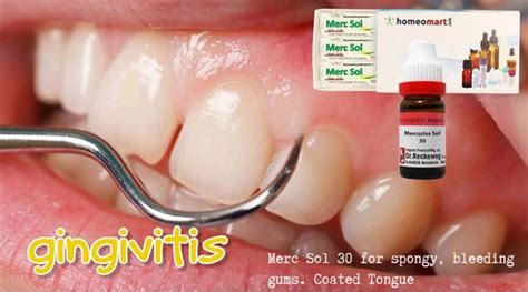 Homeopathy for Gingivitis | Remedies for Bleeding, Swollen Gums ...