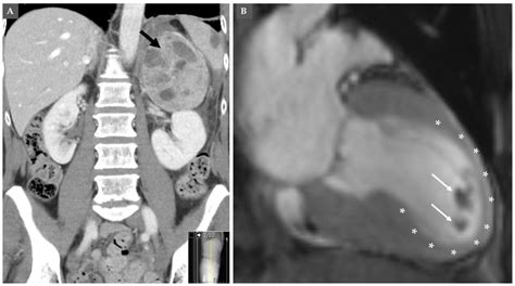 Cardiovascular Manifestations and Complications of Pheochromocytomas ...