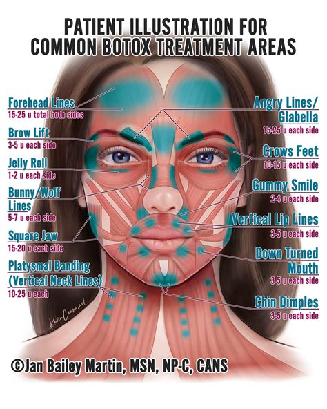 Image result for Botox Injection Patterns