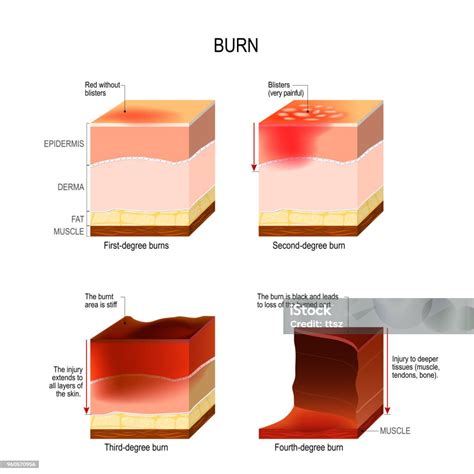 Skin Burn Four Degrees Of Burns Stock Illustration - Download Image Now ...