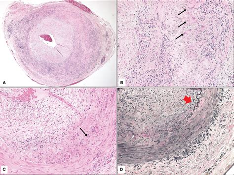 Frontiers | Giant cell temporal arteritis: a clinicopathological study with emphasis on ...
