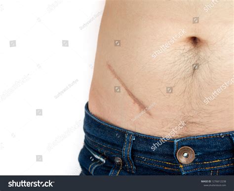 Image result for Appendix Surgery Scar