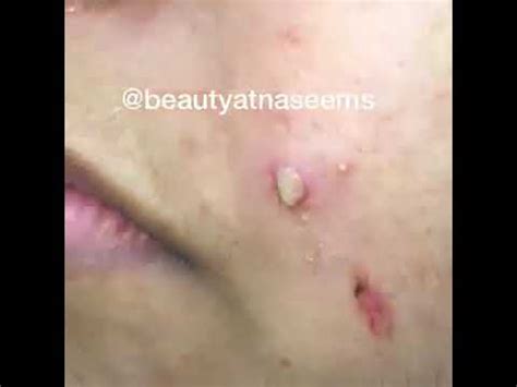 Image result for Worst Exploding Pimple