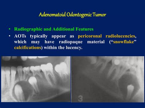 Odontogenic tumors ppt | PPTX