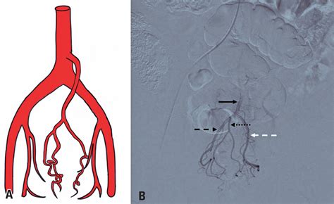SciELO - Brasil - Angiographic description of the superior rectal artery and its anatomical ...