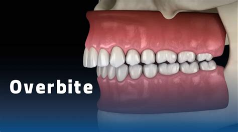 Overbite Teeth Treatment Correcting An Overbite Morley Orthodontic