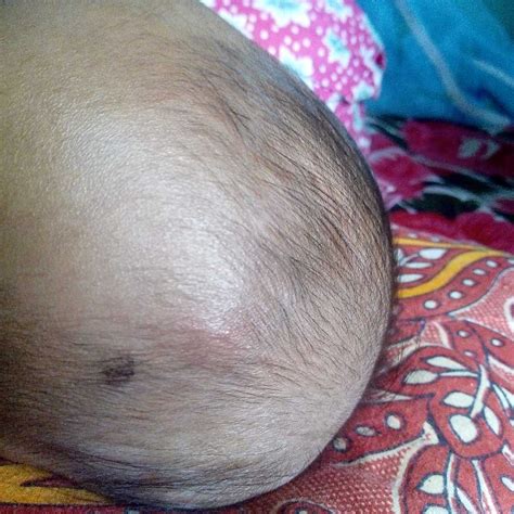 Lump Above Belly Button