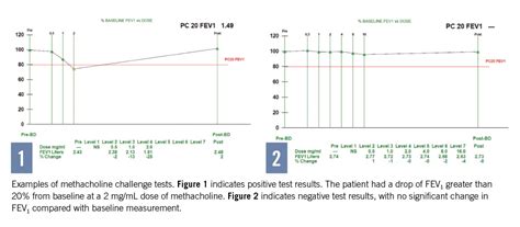 Challenging the Diagnosis of Asthma With Methacholine | Consultant360