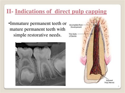 Image result for Direct Pulp Capping Vs RCT