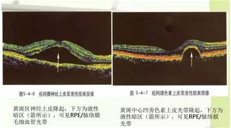 视网膜正常oct图_绝对干货视频第三弹正常OCT分层教你阅读-CSDN博客