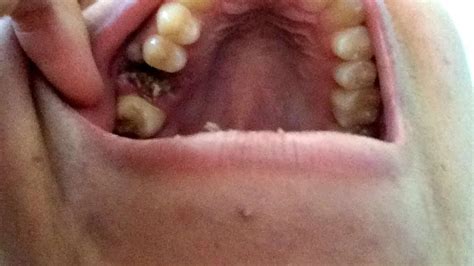 Image result for Tooth Extraction Dry Socket