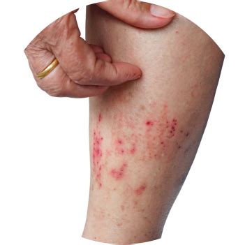 Pure & Natural Tea Tree Oil for Dandruff- Shoprythm