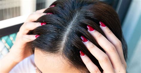 Reasons For Dandruff: Symptoms And Remedies To Get Rid Of It | Femina.in