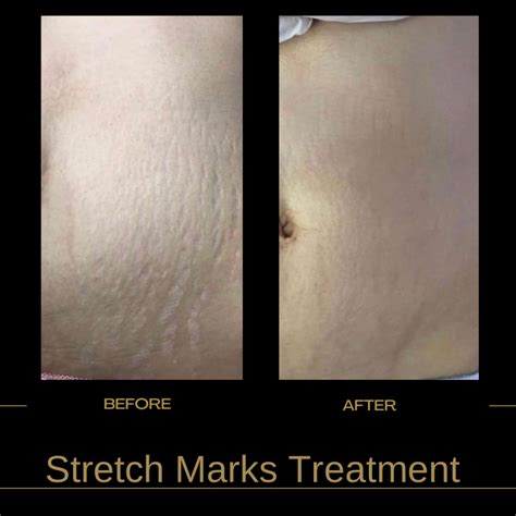 Stretch Marks Treatment - Beauty Empire Aesthetics Tampa