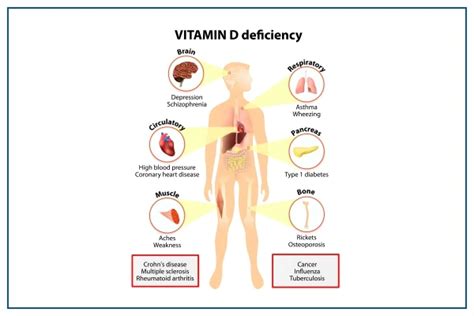 Vitamin D Deficiency: Causes, Symptoms, Food, and Treatment
