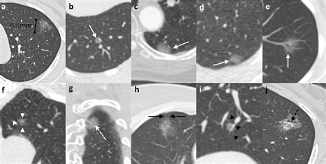 Thin-section computed tomography–histopathologic comparisons of pulmonary focal interstitial ...
