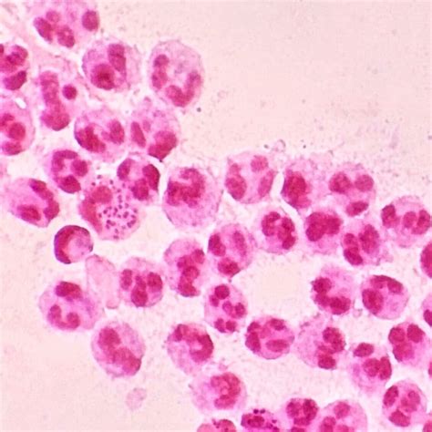 Gram stain of a urethral discharge from a young male, showing polymorphonuclear cells and ...