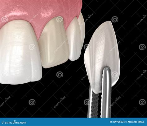 Dental Veneer Installation Procedure Over Central Incisor. 3D ...