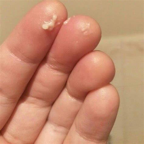 Clumpy Discharge 的图像结果