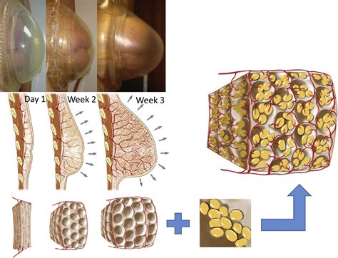 Tissue-Engineered Autologous Breast Regeneration with Brava®-Assisted Fat Grafting - Clinics in ...