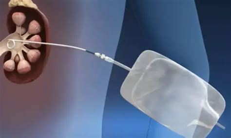 Image result for Flank Incision Nephrectomy