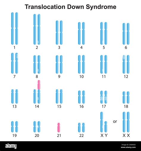 Translocation Down Syndrome Karyotype
