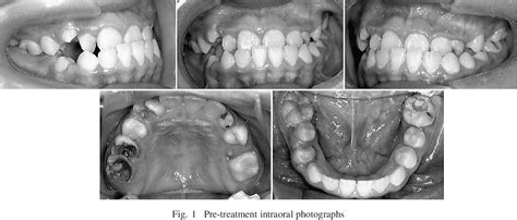 Image result for Crossbite Treatment Options