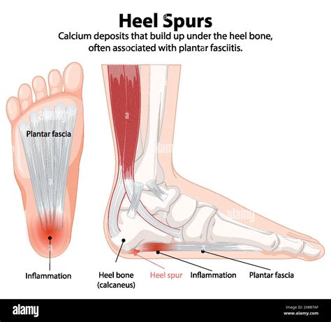 Illustration of heel spurs and plantar fasciitis Stock Vector Image ...