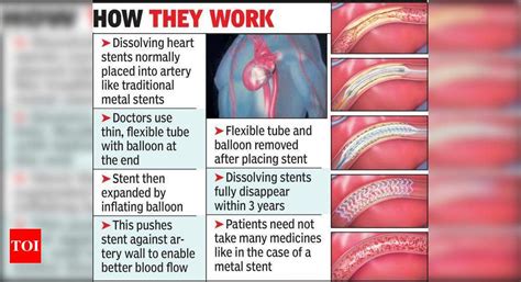 Use of dissolving heart stents now becoming commonplace | Nagpur News ...