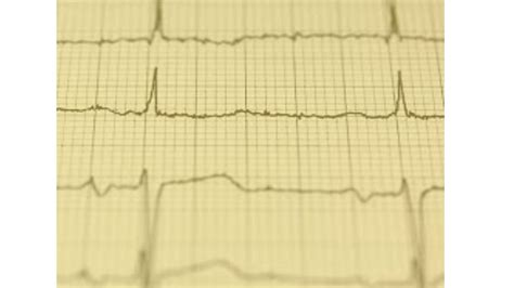 Effective Homeo Remedies for Managing Heart Palpitations