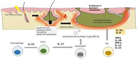 The Development of Systemic Inflammatory Diseases in Hidradenitis Suppurativa