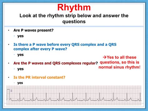 Normal ECG Read Out 的图像结果