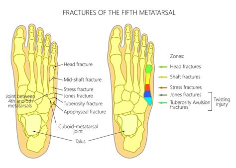 Metatarsal Base Fracture | Apophysis of the proximal 5th metatarsal ...
