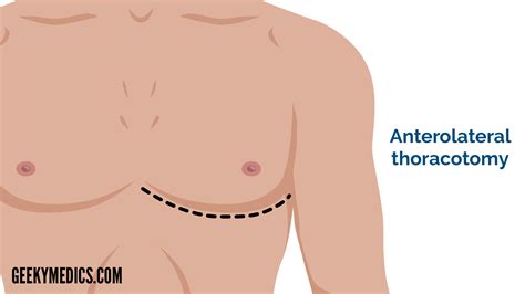 Image result for Clamshell Thoracotomy Cartoon