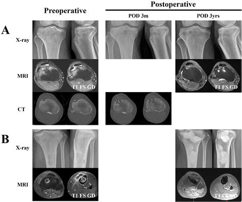 New Alternative Surgical Technique for Managing Proximal Tibia Chronic ...