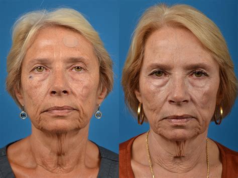 Patient 122406417 | Mohs Surgery and Skin Cancer Before & After Photos | Clevens Face and Body ...