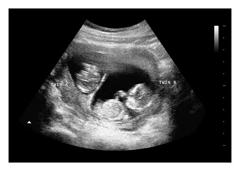 12 Week Ultrasound Twins