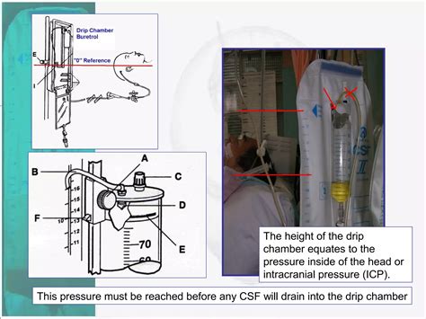 External Ventricular Drain | PPT