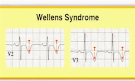 Rare Case of Wellens syndrome progressing from type A to classic type B ...