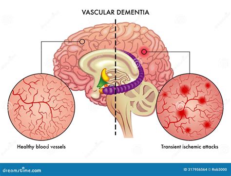 Vascular Dementia. Common Type Of Dementia Caused By Reduced Blood Cartoon Vector ...