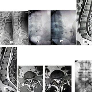 Image result for L4 Selective Nerve Root Block