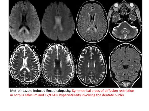 Amol toxic and metabolic encephalopathy syndrome | PPTX