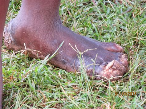 What Is Jigger Infestation at George Hodge blog