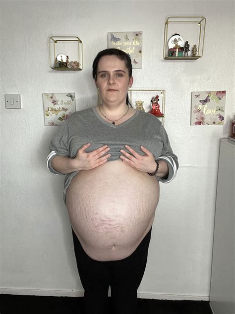 I had a huge 35-pound cyst — people thought I was pregnant