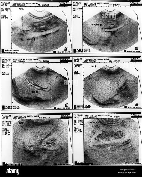 Abdominal Ultrasound Scan Stock Photo - Alamy