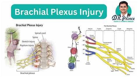 Brachial Plexus Injury - topplasticsurgery