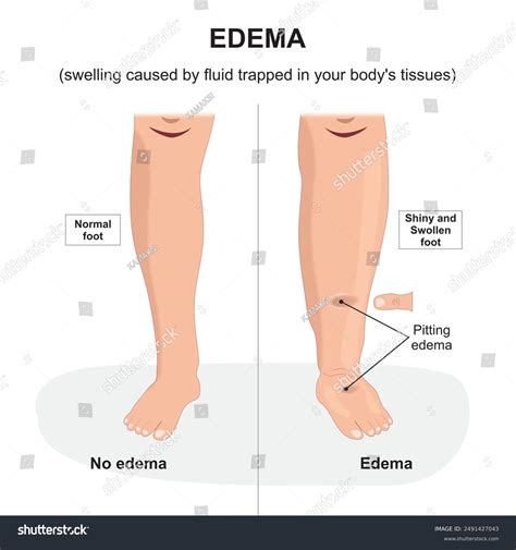 Pitting Edema Pitting Oedema | Signs MedSchool