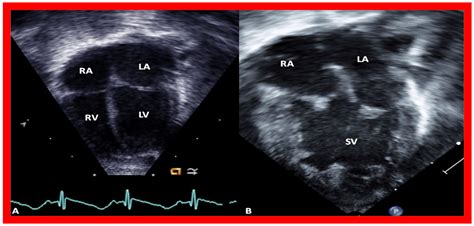 Double-Inlet Left Ventricle